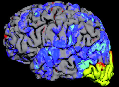 Side Profile of a Brain Scan with Highlighted Regions of Activity