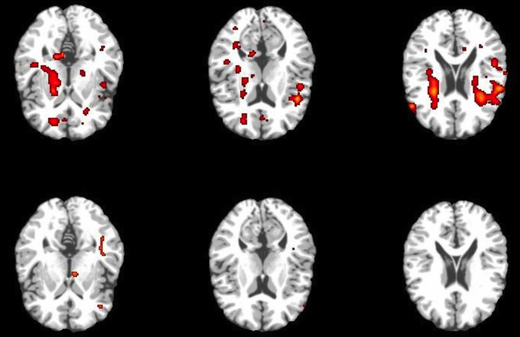 Six Brain Scan Images with Highlights of Activity for Comparison